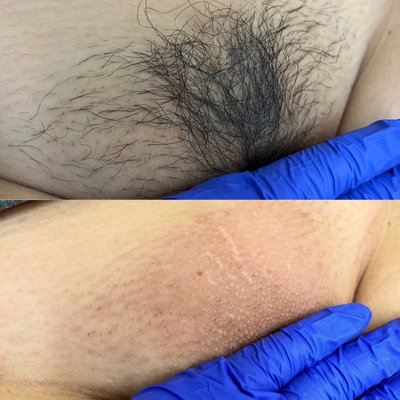 Before and After - This is your sign to Throw your Razor away! Why shave every other day? When you can wax once a month💕 Before and After - This is your sign to Throw your Razor away! Why shave every other day? When you can wax once a month💕