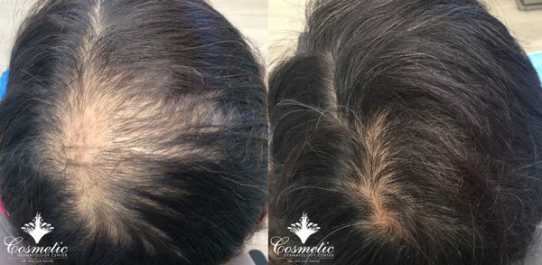 Hair PRP Treatment - This patient had suffered from alopecia areata. She received 4 PRP injection treatments 1 month apart. Results significantly improved at 3 months. Hair PRP Treatment - This patient had suffered from alopecia areata. She received 4 PRP injection treatments 1 month apart. Results significantly improved at 3 months.
