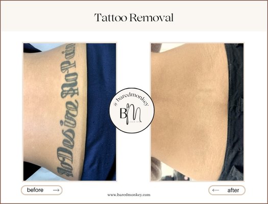 Tattoo Removal - With three different most advanced pico lasers, we can delivery unmatching results with most affordable price to anyone. Tattoo Removal - With three different most advanced pico lasers, we can delivery unmatching results with most affordable price to anyone.