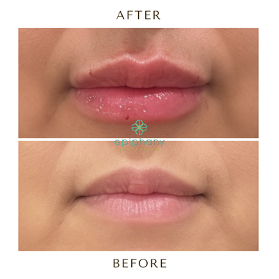 Lip Filler| Before & After - Dermal Fillers using Restylane have gained significant popularity as a sought-after non-surgical solution for those aiming to rejuvenate their skin. These fillers are carefully crafted to replenish volume and suppleness, effectively diminishing wrinkles and pronounced facial creases. Restylane’s science is based on hyaluronic acid, a compound organically present in our bodies. When introduced into the skin, this filler acts like a magnet for water molecules, ensuring instantaneous volume boost and deep hydration. Areas commonly benefit from this treatment encompass the lips, cheeks, nasolabial folds, and the delicate region beneath the eyes. Lip Filler| Before & After - Dermal Fillers using Restylane have gained significant popularity as a sought-after non-surgical solution for those aiming to rejuvenate their skin. These fillers are carefully crafted to replenish volume and suppleness, effectively diminishing wrinkles and pronounced facial creases. Restylane’s science is based on hyaluronic acid, a compound organically present in our bodies. When introduced into the skin, this filler acts like a magnet for water molecules, ensuring instantaneous volume boost and deep hydration. Areas commonly benefit from this treatment encompass the lips, cheeks, nasolabial folds, and the delicate region beneath the eyes.