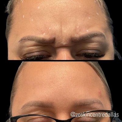 Botox | Xeomin | Daxxify | Dysport - Botox | Xeomin | Daxxify | Dysport before and after at ZO Skin Centre Dallas Botox | Xeomin | Daxxify | Dysport - Botox | Xeomin | Daxxify | Dysport before and after at ZO Skin Centre Dallas