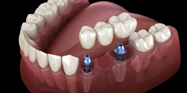 $3850 Complete Dental Implant Package - $100 discounted dental consultation to get qualified for our $3850 dental implant special includes: surgery, abutment, and final crown.Call us now for more details.
