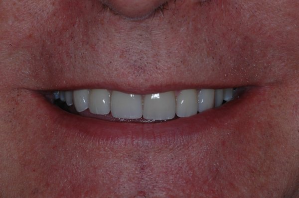 Veneers on worn teeth - For years this patient had issues with grinding his teeth which led to the edges of the teeth cracking and wearing down. We restored the patient's front teeth with ceramic veneers not only to improve the appearance of the teeth but to give him smooth straight edges that allow him to have a protective interaction between his upper and lower teeth when he grinds. Veneers on worn teeth - For years this patient had issues with grinding his teeth which led to the edges of the teeth cracking and wearing down. We restored the patient's front teeth with ceramic veneers not only to improve the appearance of the teeth but to give him smooth straight edges that allow him to have a protective interaction between his upper and lower teeth when he grinds.