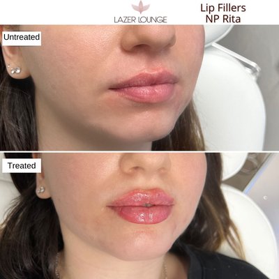 Lip fillers - Lip augmentation is a great way to add volume to replenish, hydrate or just simply add make them bigger Lip fillers - Lip augmentation is a great way to add volume to replenish, hydrate or just simply add make them bigger