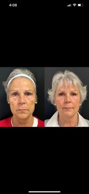 NeoGen - NeoGen PSR is a one-of-a-kind skin resurfacing treatment that improves dermal elasticity to firm, tone, and smooth the skin on your face, neck, and body. It is the first and only treatment clinically proven to regenerate skin rather than simply improve its appearance.
NeoGen skin regeneration addresses:
Fine lines and deep wrinkles
Pigmentation, age spots, and sun damage
Scarring on the face and body
Loose skin on the upper and lower eyelids
Large pores
Actinic and seborrheic keratosis
Active acne and acne scars
Skin laxity in your jawline, jowl, and mid-face NeoGen - NeoGen PSR is a one-of-a-kind skin resurfacing treatment that improves dermal elasticity to firm, tone, and smooth the skin on your face, neck, and body. It is the first and only treatment clinically proven to regenerate skin rather than simply improve its appearance.
NeoGen skin regeneration addresses:
Fine lines and deep wrinkles
Pigmentation, age spots, and sun damage
Scarring on the face and body
Loose skin on the upper and lower eyelids
Large pores
Actinic and seborrheic keratosis
Active acne and acne scars
Skin laxity in your jawline, jowl, and mid-face