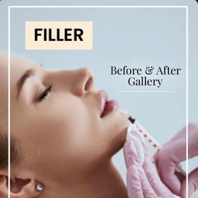 Fillers - Dermal fillers are a cosmetic treatment which involves small injections that are used to add volume to the soft tissue in the face – in areas such as the cheek, mouth, lips, around the eye and the jawline – combatting signs of ageing by filling in wrinkles and targeting hollow areas, as well as thinning lips. Fillers - Dermal fillers are a cosmetic treatment which involves small injections that are used to add volume to the soft tissue in the face – in areas such as the cheek, mouth, lips, around the eye and the jawline – combatting signs of ageing by filling in wrinkles and targeting hollow areas, as well as thinning lips.