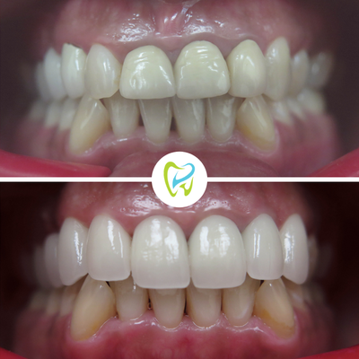 Veneers Before/After Transformations! - Do you want a smile that you're proud to share with others? Our porcelain veneers are a popular choice for getting a strong and beautiful movie star smile.
At Downey Dental Arts, we know how discouraging having discolored, damaged and unsightly teeth can feel. That is why we offer the very best in porcelain veneers and personalized dental care. You can be confident that we'll give you the most beautiful smile you've ever had. Please contact us to schedule a consultation. (562) 239-2752 https://www.dentistrydowney.com/ Veneers Before/After Transformations! - Do you want a smile that you're proud to share with others? Our porcelain veneers are a popular choice for getting a strong and beautiful movie star smile.
At Downey Dental Arts, we know how discouraging having discolored, damaged and unsightly teeth can feel. That is why we offer the very best in porcelain veneers and personalized dental care. You can be confident that we'll give you the most beautiful smile you've ever had. Please contact us to schedule a consultation. (562) 239-2752 https://www.dentistrydowney.com/