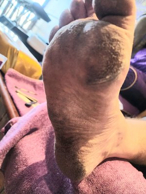 Callous Treatment Before & After - Tired of Dry Calloused Feet? We have a solution-Experience The Best most Gentle Callous Removal and luxurious foot treatment with our Signature Spa Pedicure with Callous Removal. Callous Treatment Before & After - Tired of Dry Calloused Feet? We have a solution-Experience The Best most Gentle Callous Removal and luxurious foot treatment with our Signature Spa Pedicure with Callous Removal.