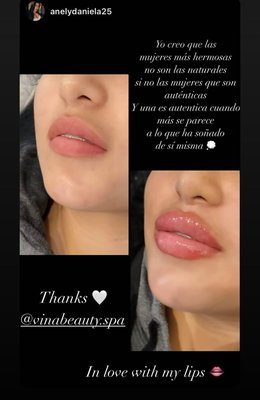 Lips Before and After - Looking and feeling beautiful is a dream of every woman, and making you feel beautiful is what are one of the core motives of Vina Beauty Spa! We aim to provide quality services to our clients and guarantee you no compromise on products used as well. Lip fillers could be a process also known as lip augmentation or lip enhancement is a style of aesthetic treatment where filler (most commonly made of mucopolysaccharide) is injected into different parts of the lips to assist voluminous them, give them definition, make them symmetrical and alter their shape.
Juvederm may be a cosmetic treatment named as a filler. you’ll easily browse on the net for lip fillers NYC if you’re residing in NY to revive facial contours and improve signs of aging. Vina beauty spa will provide the best lip fillers NYC services
The procedure to inject the merchandise takes 15 to hr. Numbing Cream is provided. Lips Before and After - Looking and feeling beautiful is a dream of every woman, and making you feel beautiful is what are one of the core motives of Vina Beauty Spa! We aim to provide quality services to our clients and guarantee you no compromise on products used as well. Lip fillers could be a process also known as lip augmentation or lip enhancement is a style of aesthetic treatment where filler (most commonly made of mucopolysaccharide) is injected into different parts of the lips to assist voluminous them, give them definition, make them symmetrical and alter their shape.
Juvederm may be a cosmetic treatment named as a filler. you’ll easily browse on the net for lip fillers NYC if you’re residing in NY to revive facial contours and improve signs of aging. Vina beauty spa will provide the best lip fillers NYC services
The procedure to inject the merchandise takes 15 to hr. Numbing Cream is provided.