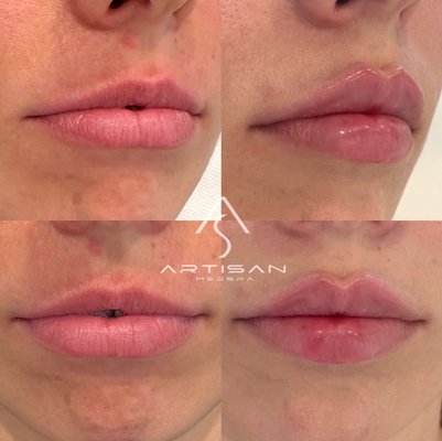 LIP Filler - 💉 Customized Consultation – Our specialists assess your lip structure and desired outcome to create a personalized treatment plan.
💋 Precision Injection Techniques – We use advanced techniques to enhance volume, shape, and hydration while maintaining a natural look.
✨ Instant, Long-Lasting Results – Enjoy immediate enhancement with results that last 6-12 months.
🩹 Minimal Downtime – Mild swelling or bruising may occur but typically subsides within a few days.

Benefits of Lip Fillers:

✔ Enhances lip volume and definition
✔ Smooths fine lines around the mouth
✔ Creates a more youthful and hydrated appearance
✔ Customizable for a subtle or dramatic look