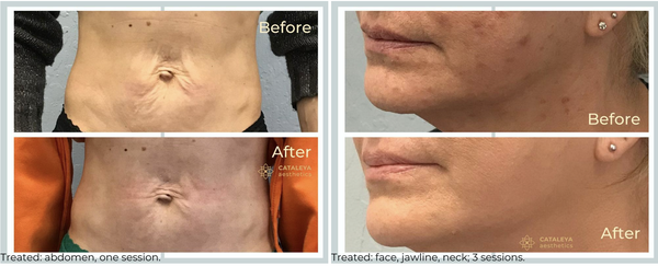 Morpheus8 RF Microneedling - Radiofrequency (RF) Microneedling is a non-invasive treatment that helps restore the texture and strength of skin damaged by sun exposure, age, stretch marks, or scarring. Cataleya Aesthetics in San Jose, California, utilizes the Morpheus8 device by Inmode. Morpheus8 treatment combines microneedling and radiofrequency to stimulate collagen production and cellular remodeling in the deep layers of the skin.