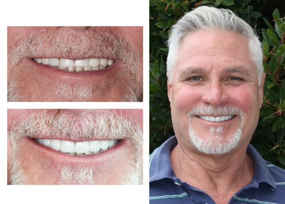 Smile makeover using porcelain veneers and crowns. - Revitalizing smile makeover was done on these patients. Very often, patient's first comment after seeing their new smile was: " Why I did not do earlier?"
A Smile Makeover using porcelain veneers can change color, position, alignment, shape of the teeth and give you the smile you have always wanted!