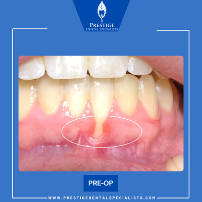 Gum Grafting - Gum grafting helps rebuild and protect receding gums, improving comfort and creating a more natural, healthy-looking smile.