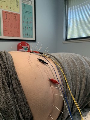 Acupuncture and Dry Needling for balancing the spine - Electro-acupuncture and dry needling techniques are used help help relieve muscle pain and improve joint function. Muscle patterns that have become worse over years, can balance quickly to reduce pain. Acupuncture and Dry Needling for balancing the spine - Electro-acupuncture and dry needling techniques are used help help relieve muscle pain and improve joint function. Muscle patterns that have become worse over years, can balance quickly to reduce pain.