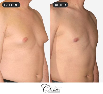 Type 2 Gynecomastia at 39 — Gland Excision, Chest & Axillary Liposuction - This 39-year-old patient came to Dr. Cruise with Type 2 gynecomastia: enlarged glandular tissue with chest fullness extending toward the underarm, plus mild skin and areola laxity. Cases like this need more than liposuction alone, because liposuction removes fat but cannot remove firm gland tissue or tighten a stretched areola.
Dr. Cruise performed a customized three-part correction: excision of the bilateral breast gland, liposuction of the chest, axillary roll, and breast roll to sculpt the surrounding contour, and a bilateral donut lift to tighten and resize the areola.
What is a donut lift? It removes a ring of skin around the areola through an incision hidden right at the areola border, reducing a stretched or puffy areola to a flatter, smaller, more masculine proportion. Because the scar sits at the natural color transition of the areola edge, it typically heals to be barely detectable.
The photographs show his results from four angles: front, oblique, and side profile, demonstrating a flat chest, tightened areolas, and a natural masculine contour, including the often-missed fullness along the axillary roll near the underarm.
Dr. Cruise is one of the nation's most experienced gynecomastia surgeons and creator of the widely used Cruise Gynecomastia Classification system. Each surgical plan is matched to the patient's gynecomastia type, skin quality, and goals. Type 2 Gynecomastia at 39 — Gland Excision, Chest & Axillary Liposuction - This 39-year-old patient came to Dr. Cruise with Type 2 gynecomastia: enlarged glandular tissue with chest fullness extending toward the underarm, plus mild skin and areola laxity. Cases like this need more than liposuction alone, because liposuction removes fat but cannot remove firm gland tissue or tighten a stretched areola.
Dr. Cruise performed a customized three-part correction: excision of the bilateral breast gland, liposuction of the chest, axillary roll, and breast roll to sculpt the surrounding contour, and a bilateral donut lift to tighten and resize the areola.
What is a donut lift? It removes a ring of skin around the areola through an incision hidden right at the areola border, reducing a stretched or puffy areola to a flatter, smaller, more masculine proportion. Because the scar sits at the natural color transition of the areola edge, it typically heals to be barely detectable.
The photographs show his results from four angles: front, oblique, and side profile, demonstrating a flat chest, tightened areolas, and a natural masculine contour, including the often-missed fullness along the axillary roll near the underarm.
Dr. Cruise is one of the nation's most experienced gynecomastia surgeons and creator of the widely used Cruise Gynecomastia Classification system. Each surgical plan is matched to the patient's gynecomastia type, skin quality, and goals.