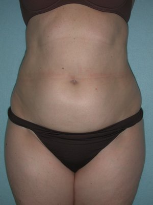 Liposuction - Liposuction involves fat removal through small incisions allowing sculpting of the areas of concern. Typical areas treated are the abdomen, love handles, back and thighs. Liposuction - Liposuction involves fat removal through small incisions allowing sculpting of the areas of concern. Typical areas treated are the abdomen, love handles, back and thighs.