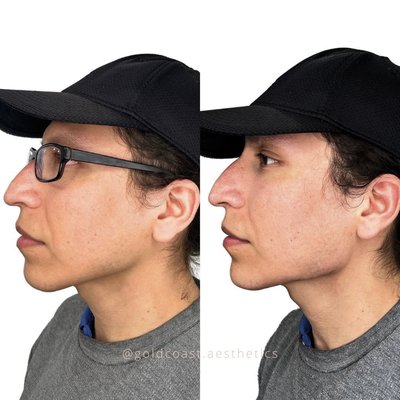 Chin & Jawline Filler - Chin & jawline filler is a beautiful way to enhance the natural contours of your features and add a bit more balance. Chin & Jawline Filler - Chin & jawline filler is a beautiful way to enhance the natural contours of your features and add a bit more balance.