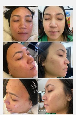 "Holistic Acne Rescue" - Acne comes in many forms and requires a tailored approach for effective care. At Gleam Esthetika, we provide personalized solutions by assessing your unique skin needs. Our holistic approach focuses on treating, healing, and preventing acne while addressing scarring. We combine advanced treatments, customized home care plans, and nutritional guidance to support your journey to clear, healthy skin. Dedicated follow-up care ensures lasting results and ongoing support every step of the way.