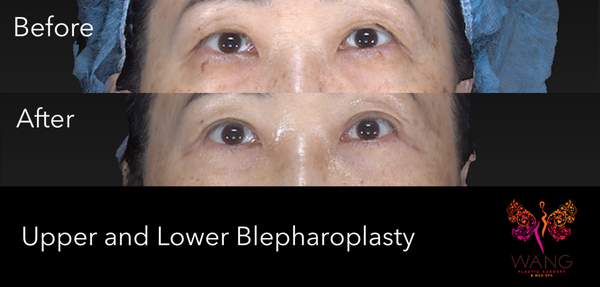 Blepharoplasty (Upper and Lower Eyelid) - Blepharoplasty is a type of surgery that repairs droopy eyelids and may involve removing excess skin, muscle and fat. As you age, your eyelids stretch, and the muscles supporting them weaken. As a result, excess fat may gather above and below your eyelids, causing sagging eyebrows, droopy upper lids and bags under the eye.
Dr. Wang's skill and dedication have earned him the trust and admiration of countless satisfied patients. Dr. Wang listens to the story of all patients ensuring that he will provide results that aligns exactly with what the patients have been looking for. His expertise is backed by a portfolio of stunning results, and his commitment to delivering the best outcomes for his patients is unwavering. When it comes to blepharoplasty, Dr. Wang is not just a surgeon; he's an artist, crafting one-of-a-kind enhancements that leave patients feeling confident and beautiful. Experience the difference with Dr. Wang and unlock the potential of your eyes like never before. Blepharoplasty (Upper and Lower Eyelid) - Blepharoplasty is a type of surgery that repairs droopy eyelids and may involve removing excess skin, muscle and fat. As you age, your eyelids stretch, and the muscles supporting them weaken. As a result, excess fat may gather above and below your eyelids, causing sagging eyebrows, droopy upper lids and bags under the eye.
Dr. Wang's skill and dedication have earned him the trust and admiration of countless satisfied patients. Dr. Wang listens to the story of all patients ensuring that he will provide results that aligns exactly with what the patients have been looking for. His expertise is backed by a portfolio of stunning results, and his commitment to delivering the best outcomes for his patients is unwavering. When it comes to blepharoplasty, Dr. Wang is not just a surgeon; he's an artist, crafting one-of-a-kind enhancements that leave patients feeling confident and beautiful. Experience the difference with Dr. Wang and unlock the potential of your eyes like never before.