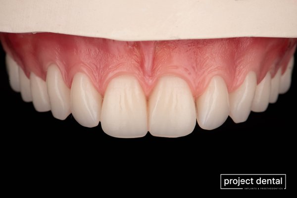 Dentures - Completely removable and custom designed to fit and look natural, complete dentures provide a complete replacement for an entire set of teeth. Dentures - Completely removable and custom designed to fit and look natural, complete dentures provide a complete replacement for an entire set of teeth.