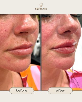 Lip Filler - Lip Filler Lip Filler - Lip Filler