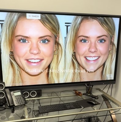 AI-Powered Artistry at BPDG 🤖💎 - Precision is everything. We use SmileCloud to digitally architect every veneer and restoration we place. By combining Dr. Bill’s 30+ years of prosthodontic expertise with cutting-edge AI, we ensure your results are as functional as they are beautiful.