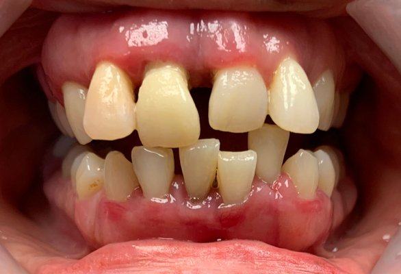 Teeth In A Day - This patient was never happy with her "gummy" smile throughout life.  She finally made the decision to replace everything with permanent bridges that attach to implants.  Due to the number of extractions, we split this case into 2 appointments