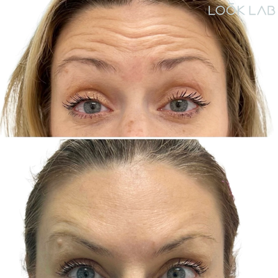 Neurotoxins - Before/After Neurotoxins - Before/After