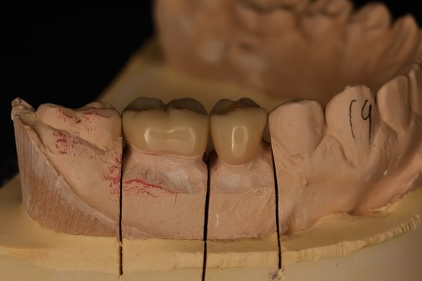 Dental crowns - Dental crowns are the ideal restorative option when a tooth has undergone too much damage. The restoration functions and looks like a natural tooth. At Sunset Dental Arts, we offer the highest quality of ceramic crowns that are guaranteed to never fracture. Dental crowns - Dental crowns are the ideal restorative option when a tooth has undergone too much damage. The restoration functions and looks like a natural tooth. At Sunset Dental Arts, we offer the highest quality of ceramic crowns that are guaranteed to never fracture.