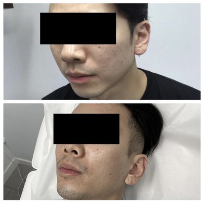 Microneedling - Microneedling is a minimally invasive cosmetic procedure that’s used to treat skin concerns via collagen production. Also known as collagen induction therapy, this treatment may help those looking to reduce the appearance of acne scars and stretch marks. Microneedling - Microneedling is a minimally invasive cosmetic procedure that’s used to treat skin concerns via collagen production. Also known as collagen induction therapy, this treatment may help those looking to reduce the appearance of acne scars and stretch marks.