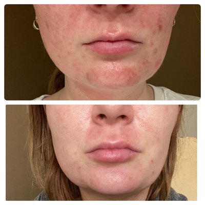 Before and afters of PCA peels on acne prone skin. - Before and after PCA peels for acne prone and hormonal acne skin. Lessons the look of scarring and helps to bring up and dry acne and sebaceous oils. Before and afters of PCA peels on acne prone skin. - Before and after PCA peels for acne prone and hormonal acne skin. Lessons the look of scarring and helps to bring up and dry acne and sebaceous oils.