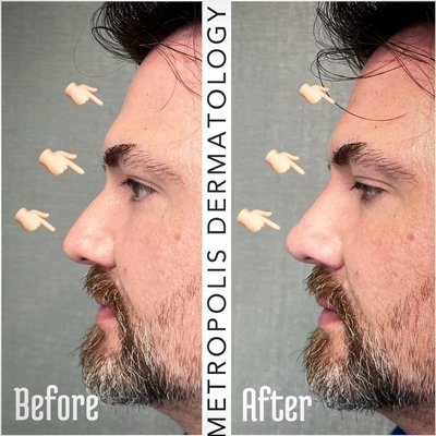 Liquid Rhinoplasty - Liquid Rhinoplasties are advanced procedures that seek to contour the nose without surgery.