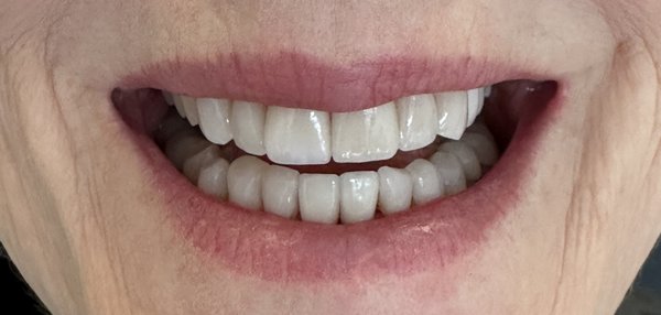 Veneers - Porcelain veneers are natural looking restorations that help correct chips, gaps and discolorations. We can help you achieve a natural look with our custom fabricated, minimal prep veneers.