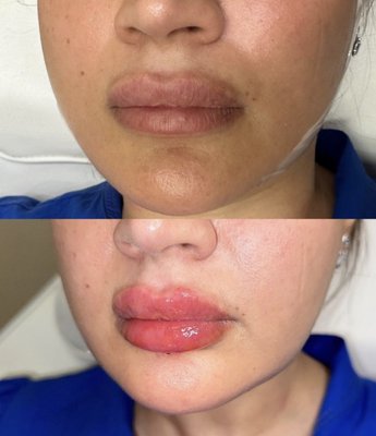 Enhance Your Lips - We offer the best quality lip fillers in the industry. Enhance Your Lips - We offer the best quality lip fillers in the industry.