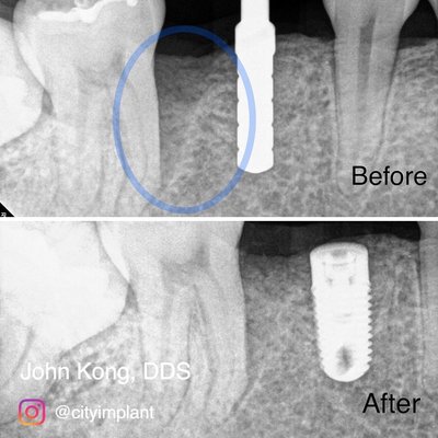 Dental implant surgery & Guided Tissue Regeneration - Periodontal bone regeneration to correct boneloss from gum disease and placement of a dental implant. Dental implant surgery & Guided Tissue Regeneration - Periodontal bone regeneration to correct boneloss from gum disease and placement of a dental implant.