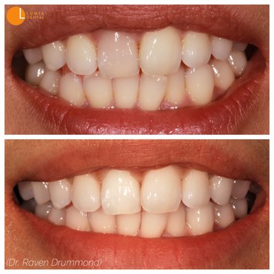 Internal Bleaching - A single tooth that is darker than the neighboring teeth is frustrating, and dampens the confidence in yourself and your smile. Internal bleaching is a completely painless endodontic procedure that is usually completed in one short 30-minute visit. The results are stunning. Internal Bleaching - A single tooth that is darker than the neighboring teeth is frustrating, and dampens the confidence in yourself and your smile. Internal bleaching is a completely painless endodontic procedure that is usually completed in one short 30-minute visit. The results are stunning.