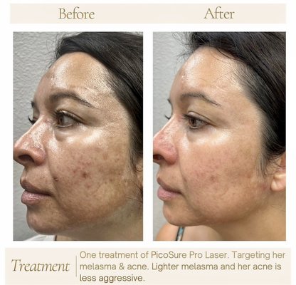 PicoSure Pro - One treatment of PicoSure Pro Laser. Targeting her melasma & acne. Lighter melasma and her acne is
less aggressive. Call and book your free consultation today! PicoSure Pro - One treatment of PicoSure Pro Laser. Targeting her melasma & acne. Lighter melasma and her acne is
less aggressive. Call and book your free consultation today!