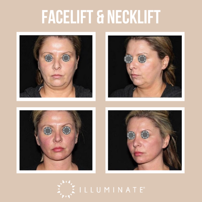 Face Procedures - Our focus is to produce long-lasting, natural-looking results. Face Procedures - Our focus is to produce long-lasting, natural-looking results.