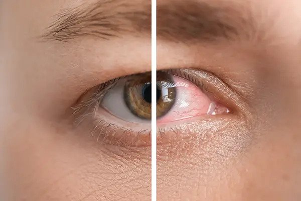 Dry Eye Treatment - At Nova Eye Institute, we provide personalized treatments tailored to the specific type & cause of your dry eye. Dry Eye Treatment - At Nova Eye Institute, we provide personalized treatments tailored to the specific type & cause of your dry eye.