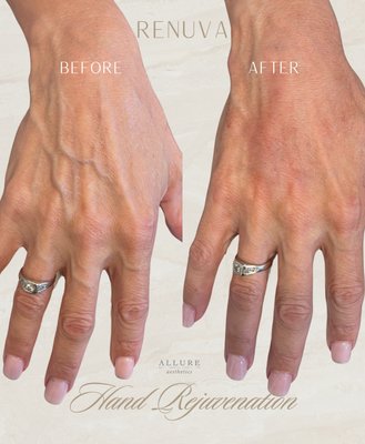 Hand Restoration - At Allure Aesthetics, our Hand Restoration treatment rejuvenates aging hands by restoring lost volume, smoothing wrinkles, and improving skin texture with Renuva. Using advanced, minimally invasive techniques, this treatment delivers naturally youthful and elegant results, leaving your hands looking revitalized and refined. Hand Restoration - At Allure Aesthetics, our Hand Restoration treatment rejuvenates aging hands by restoring lost volume, smoothing wrinkles, and improving skin texture with Renuva. Using advanced, minimally invasive techniques, this treatment delivers naturally youthful and elegant results, leaving your hands looking revitalized and refined.