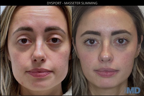 Fillers - Curious about the results of cosmetic injectables? See the stunning transformations we’ve achieved using advanced techniques in:
Undereye Filler – Brighten tired eyes and reduce hollowness for a refreshed, youthful appearance.
Nose Filler (Non-Surgical Rhinoplasty) – Subtly sculpt and balance your profile without surgery.
Facial Filler – Restore lost volume, enhance contours, and rejuvenate your natural beauty.
Lip Filler – From subtle definition to fuller volume, we create lips that enhance your features.
Chin Filler – Define and balance the lower face with natural-looking chin enhancement.
Dysport/Botox – Smooth fine lines and soften expression lines for a youthful, rested look.
Our gallery features real client results performed by trained professionals using premium products and techniques tailored to each individual. Fillers - Curious about the results of cosmetic injectables? See the stunning transformations we’ve achieved using advanced techniques in:
Undereye Filler – Brighten tired eyes and reduce hollowness for a refreshed, youthful appearance.
Nose Filler (Non-Surgical Rhinoplasty) – Subtly sculpt and balance your profile without surgery.
Facial Filler – Restore lost volume, enhance contours, and rejuvenate your natural beauty.
Lip Filler – From subtle definition to fuller volume, we create lips that enhance your features.
Chin Filler – Define and balance the lower face with natural-looking chin enhancement.
Dysport/Botox – Smooth fine lines and soften expression lines for a youthful, rested look.
Our gallery features real client results performed by trained professionals using premium products and techniques tailored to each individual.