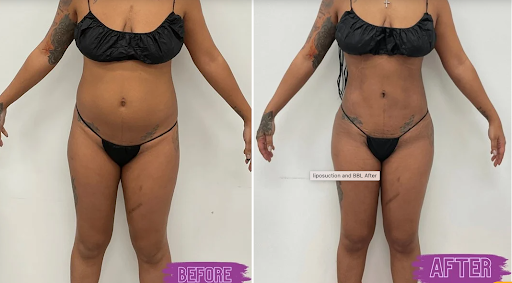 Liposuction - Even though you diet and exercise, you might still be bothered by pockets of fat that are keeping you from feeling completely confident in how you look. Jubilee Cosmetic Surgery offers the most advanced methods to safely remove fat from the body. Liposuction surgery is a body contouring treatment that reduces pockets of fat from the flanks, tummy, buttocks, and thighs to create a more defined appearance. This cosmetic procedure at Jubilee Cosmetic Surgery can be blended to treat multiple body parts. When we see you for your in-depth consultation at our office in Silver Spring, MD, board-certified surgeon Dr. Tsion Berhane will assess areas of your body you wish to address so you can attain your personal goals. Our goal is for you to look and feel your absolute best. Liposuction - Even though you diet and exercise, you might still be bothered by pockets of fat that are keeping you from feeling completely confident in how you look. Jubilee Cosmetic Surgery offers the most advanced methods to safely remove fat from the body. Liposuction surgery is a body contouring treatment that reduces pockets of fat from the flanks, tummy, buttocks, and thighs to create a more defined appearance. This cosmetic procedure at Jubilee Cosmetic Surgery can be blended to treat multiple body parts. When we see you for your in-depth consultation at our office in Silver Spring, MD, board-certified surgeon Dr. Tsion Berhane will assess areas of your body you wish to address so you can attain your personal goals. Our goal is for you to look and feel your absolute best.