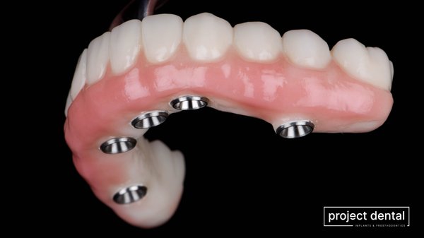 Full arch dental implants - A Full arch dental implant is a treatment option that replaces an entire arch of teeth at once using multiple dental implants and a natural-looking full arch ceramic restoration. Full arch implant restorations are completely fixed to the dental implants so you don’t have to worry about lack of retention, stability, or support as with the traditional dentures. Full arch dental implants - A Full arch dental implant is a treatment option that replaces an entire arch of teeth at once using multiple dental implants and a natural-looking full arch ceramic restoration. Full arch implant restorations are completely fixed to the dental implants so you don’t have to worry about lack of retention, stability, or support as with the traditional dentures.