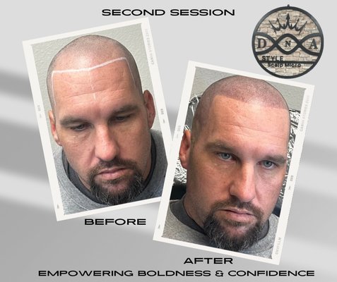 DNA Style Scalp Micro - Scalp Micropigmentation (SMP) offers a life-changing solution, giving you a freshly shaved appearance, hiding scars, and blending perfectly with your natural hair - minus the everyday upkeep.
Revamp your style, regain your confidence, and take control of your look! DNA Style Scalp Micro - Scalp Micropigmentation (SMP) offers a life-changing solution, giving you a freshly shaved appearance, hiding scars, and blending perfectly with your natural hair - minus the everyday upkeep.
Revamp your style, regain your confidence, and take control of your look!