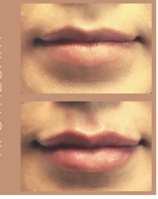 Lip Filler - Restore lips to a more youthful volume or get the lips you wish you had been born with. Your nurse will be your guide to help you find the perfect amount of volume and the perfect filler choice for you. Lip Filler - Restore lips to a more youthful volume or get the lips you wish you had been born with. Your nurse will be your guide to help you find the perfect amount of volume and the perfect filler choice for you.