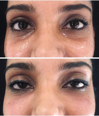 Before / After Dermal Fillers - Actual photos of our clients after receiving dermal fillers by injection specialist, Lori Myers. Medical dermal fillers create volume, thereby: 1. Restoring lost volume and returning a more youthful appearance and/or 2. Re-shaping facial features for a more aesthetically appealing look.