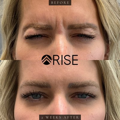 Tox Treatment - This patient received Botox injections in her upper & lower face to smooth out the appearance of her skin & reduce any fine lines and wrinkles. Tox Treatment - This patient received Botox injections in her upper & lower face to smooth out the appearance of her skin & reduce any fine lines and wrinkles.