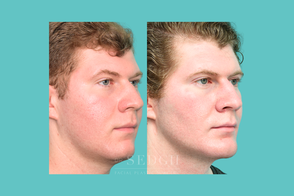 Buccal Fat - Explore buccal fat removal before and after results by Dr. Jacob Sedgh in Beverly Hills, enhancing cheek definition and facial contours.