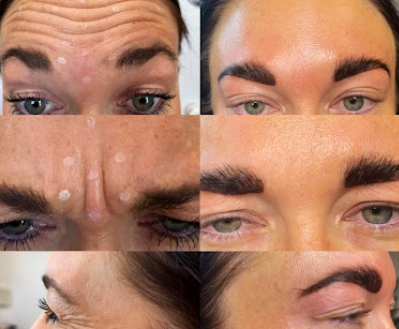Botox, Dysport, Xeomin, and Fillers - Nurse Injector Jessica offers treatments ranging from Botox Facials to Dysport Injections to Kybella and more! Botox, Dysport, Xeomin, and Fillers - Nurse Injector Jessica offers treatments ranging from Botox Facials to Dysport Injections to Kybella and more!