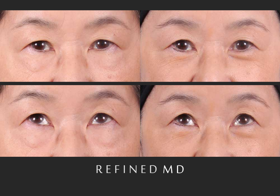 Lower Eyelid Surgery Gallery - Aging of the lower eyelids is typically associated with the development of crepey, lax skin, volume loss around the bony orbital rim and upper cheek as well as bulging of fat pads around the eyes. There are a few ways to perform lower eyelid surgery, depending on your skin and goals. Call board certified facial plastic surgeon Dr. Sudeep Roy today to schedule a consultation at RefinedMD in Los Gatos. Lower Eyelid Surgery Gallery - Aging of the lower eyelids is typically associated with the development of crepey, lax skin, volume loss around the bony orbital rim and upper cheek as well as bulging of fat pads around the eyes. There are a few ways to perform lower eyelid surgery, depending on your skin and goals. Call board certified facial plastic surgeon Dr. Sudeep Roy today to schedule a consultation at RefinedMD in Los Gatos.